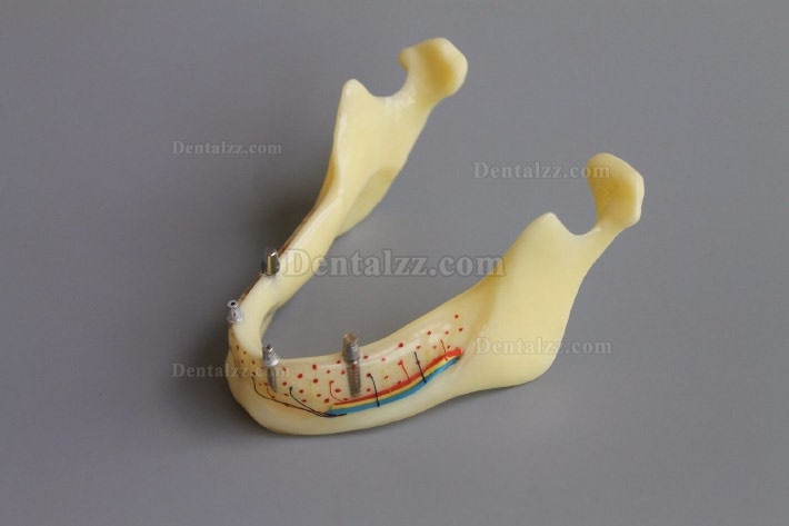 歯科模型＃2014 02 - 下顎インプラントとオーバーデンチャーモデル（黄色）